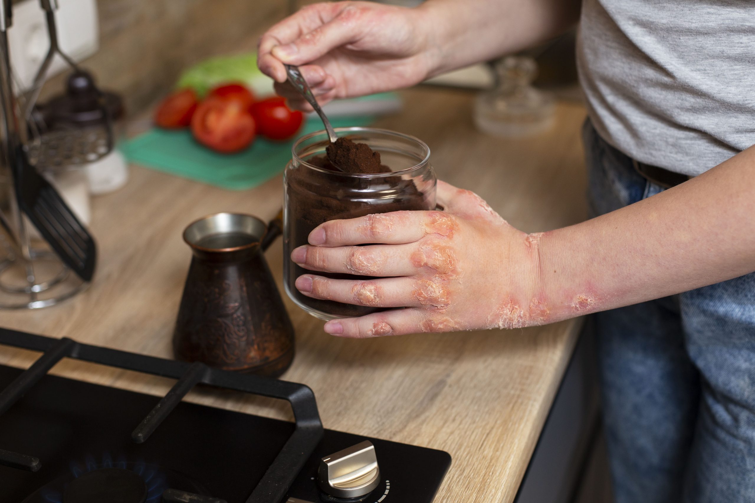 Eczema vs Psoriasis: An Ayurvedic Guide to Understanding the Differences
